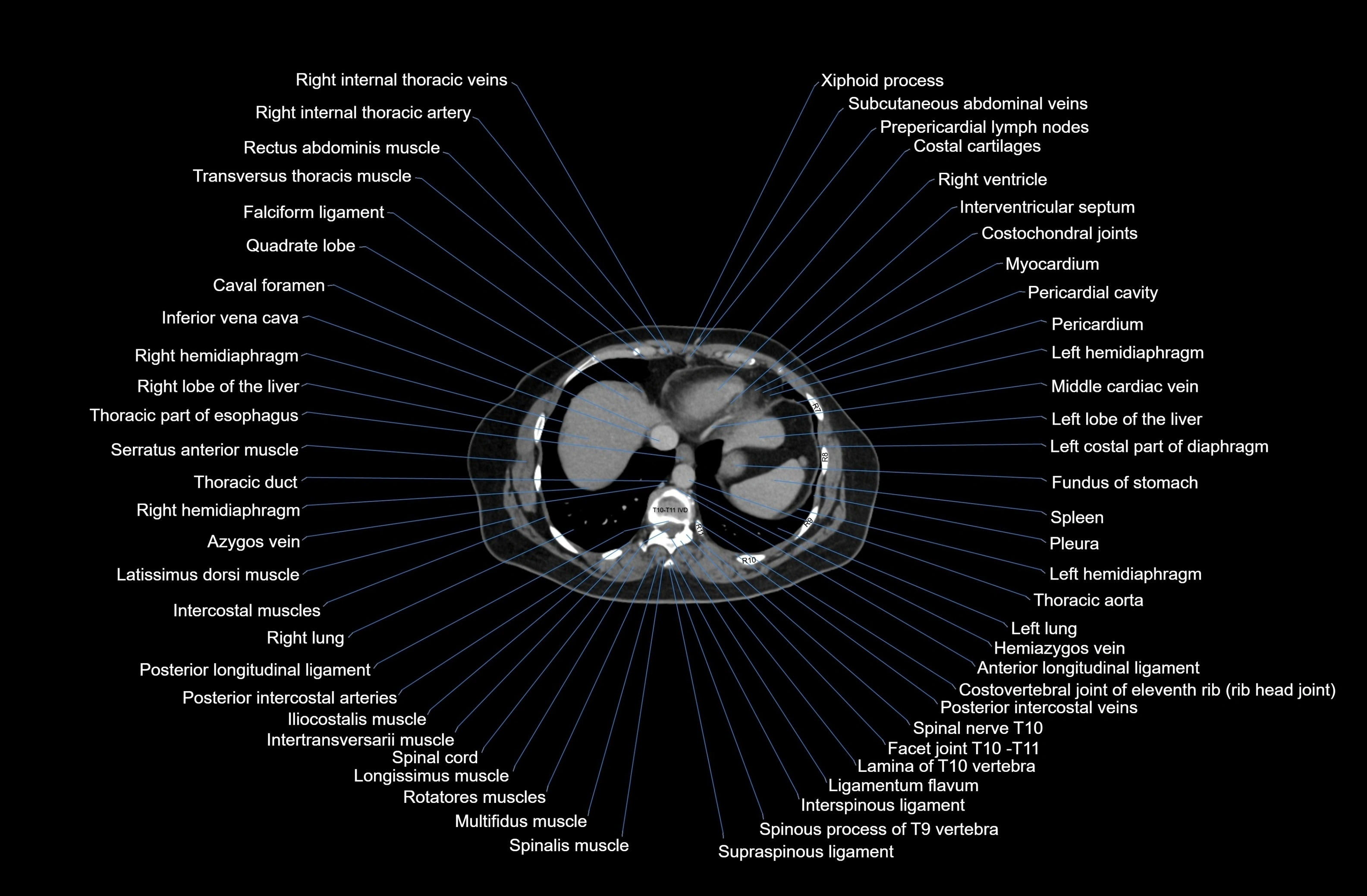CT Abdomen axial cross sectional anatomy labelled radiology image-00008.webp